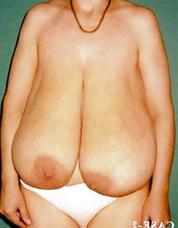 25P Fat Tits