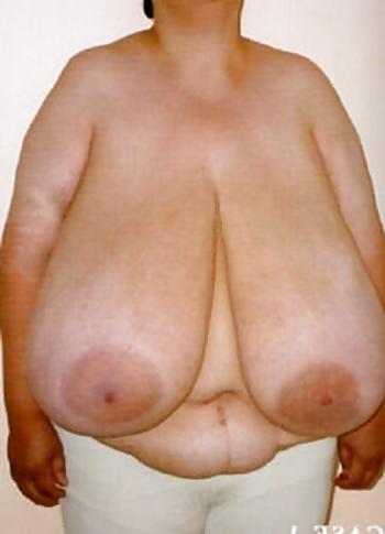 25P Fat Tits