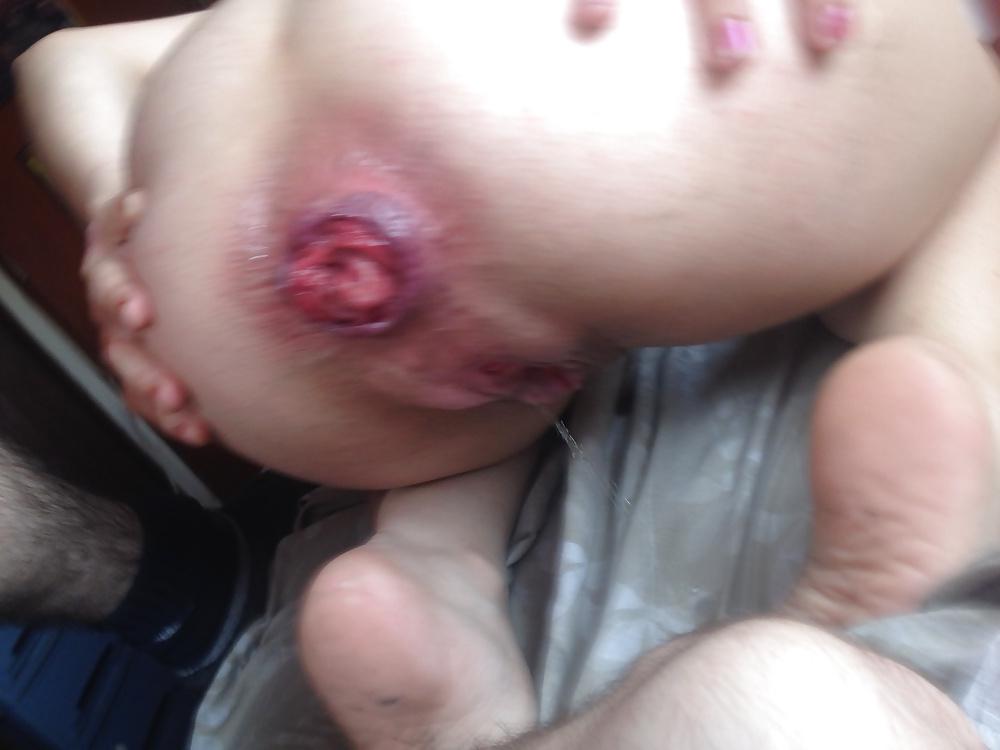 19P Prolapse teen 