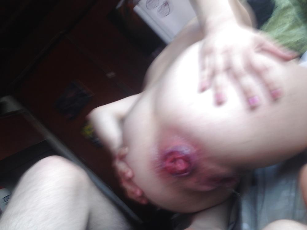 19P Prolapse teen 