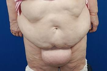 13P Fat pussy mounds fettfotze grote venusheuvels