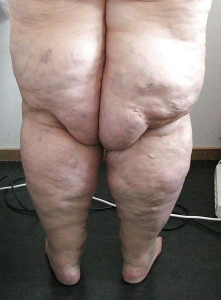 25P Sexy fette Beine - Sexy fat legs