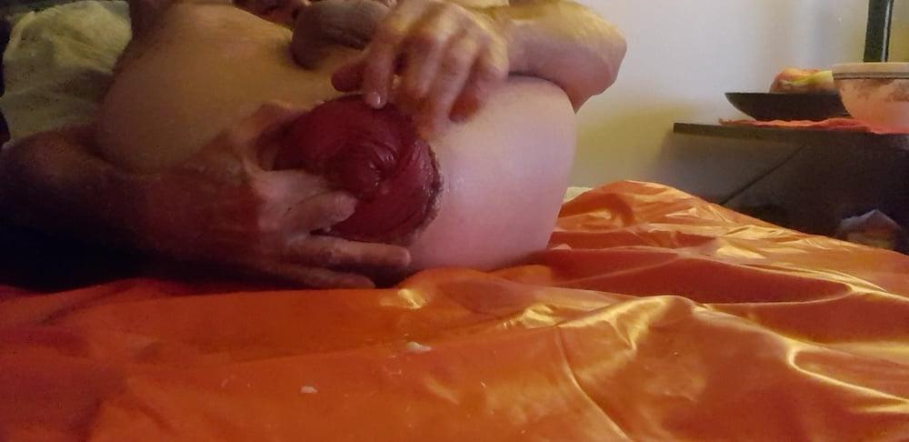 25P Extension prolapse
