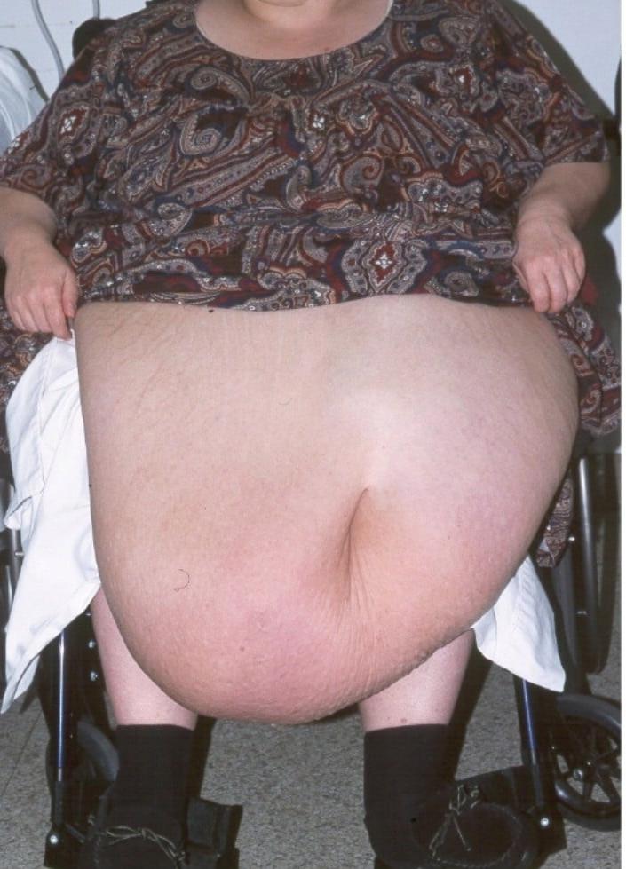 25P SSBBW Immobilised By Fat
