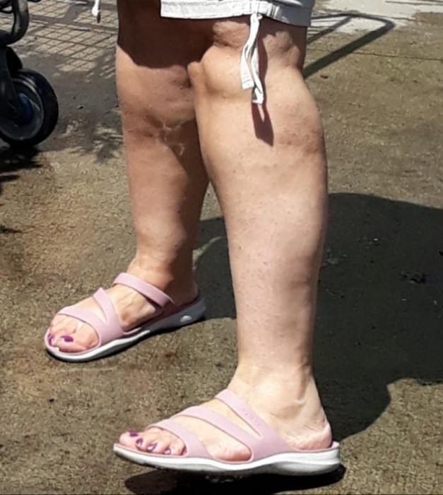 25P cellulite sluts 2 . very fat arms, flabby ass, cellulite leg