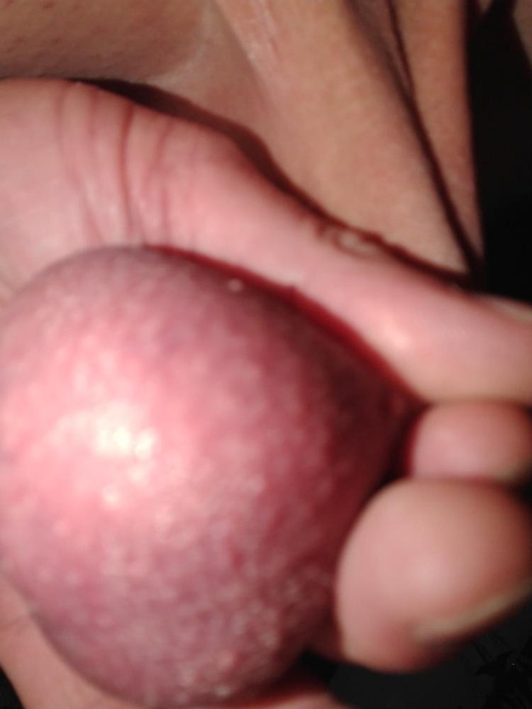 11P Eier
