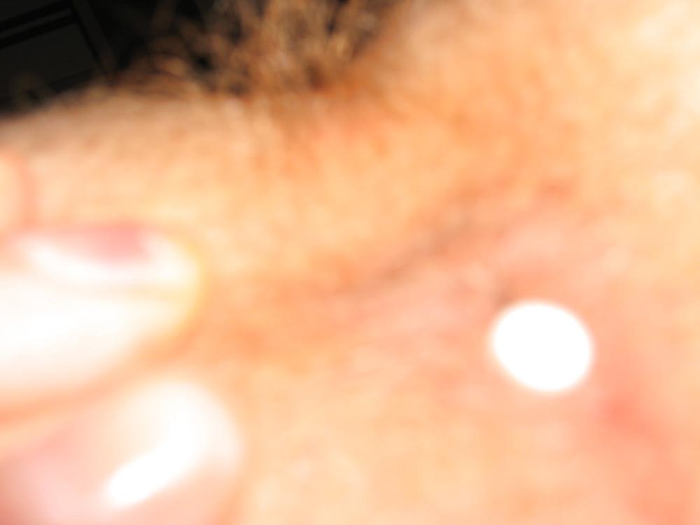24P Rectal temp and suppository