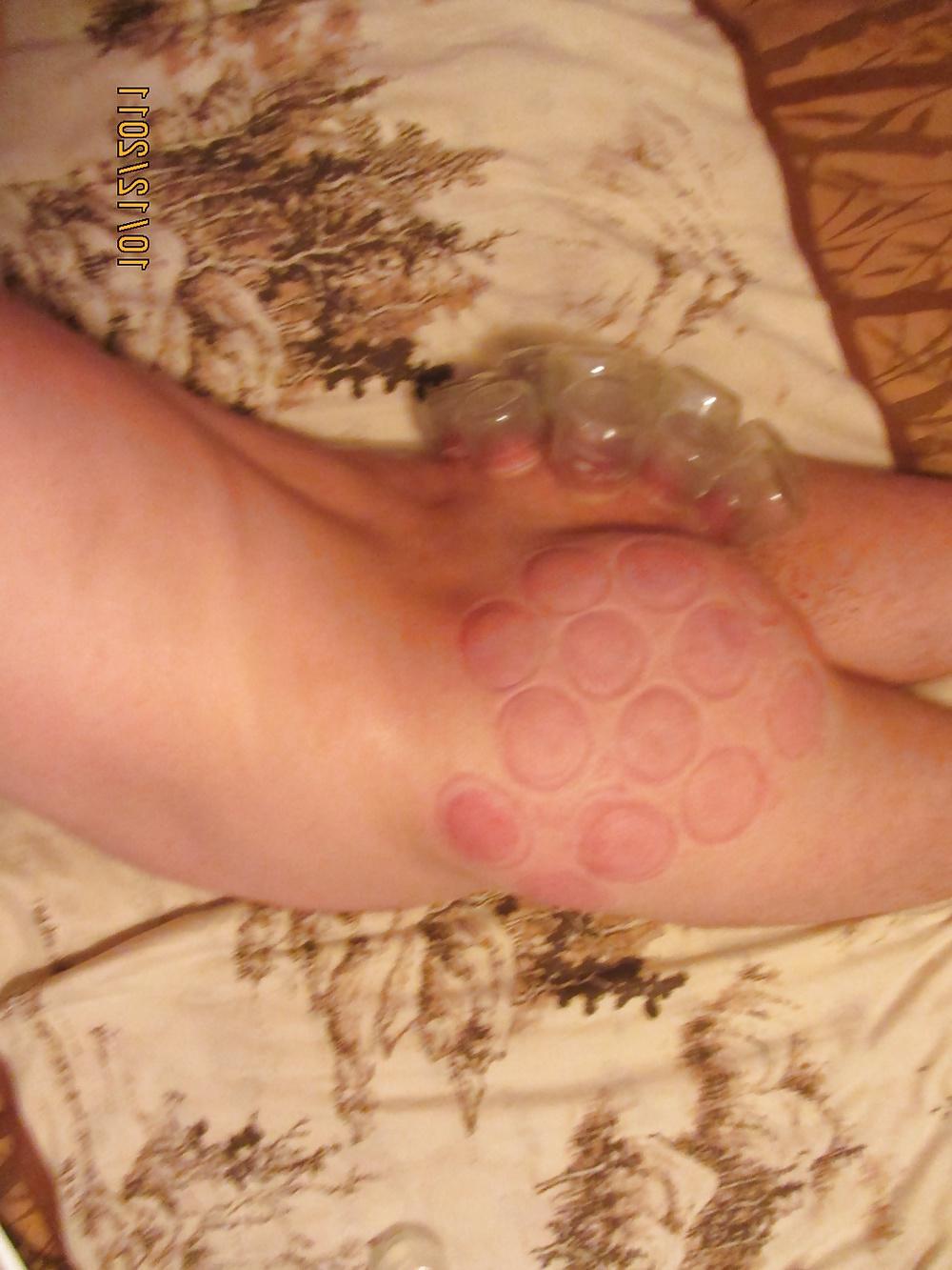 11P Vacuum (fire cupping) ass torture