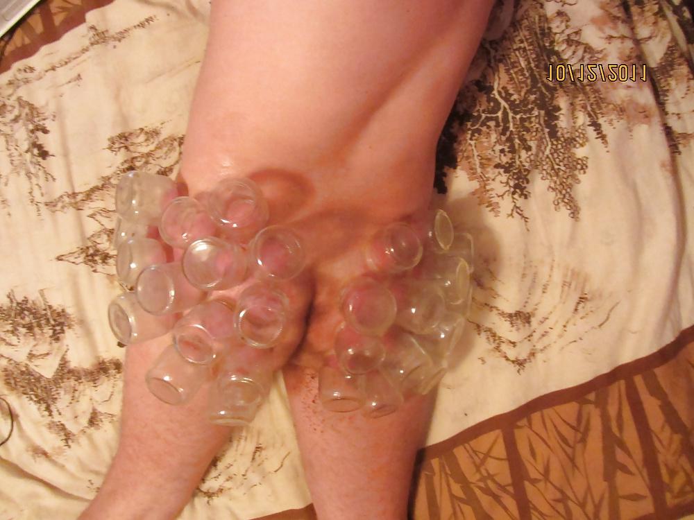 11P Vacuum (fire cupping) ass torture