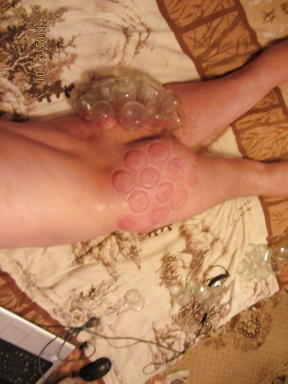 11P Vacuum (fire cupping) ass torture