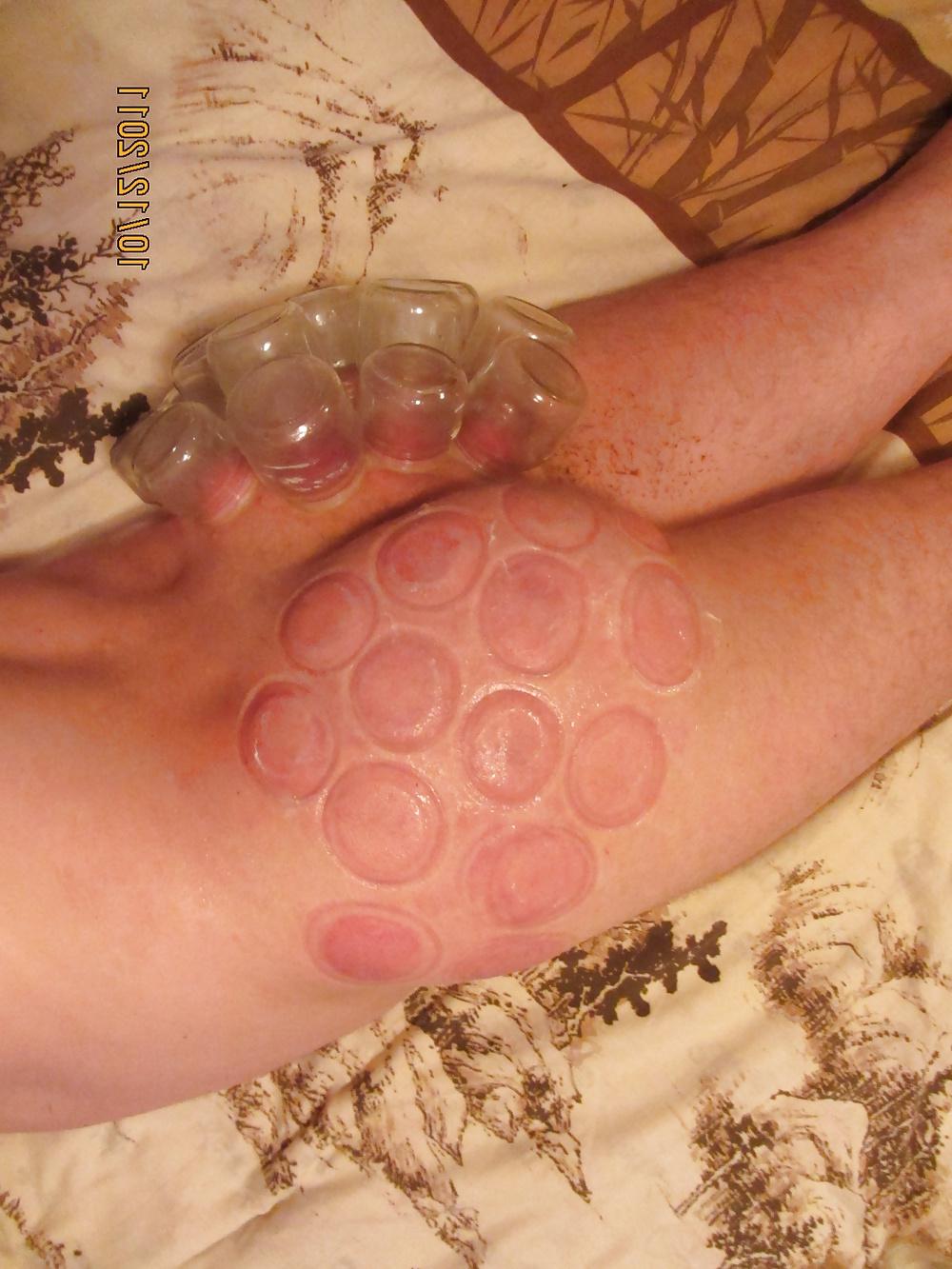 11P Vacuum (fire cupping) ass torture