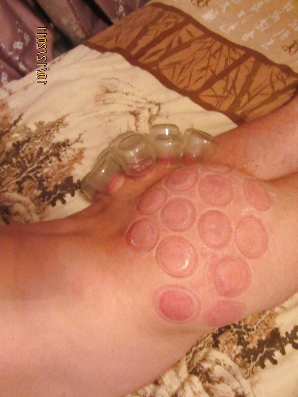 11P Vacuum (fire cupping) ass torture