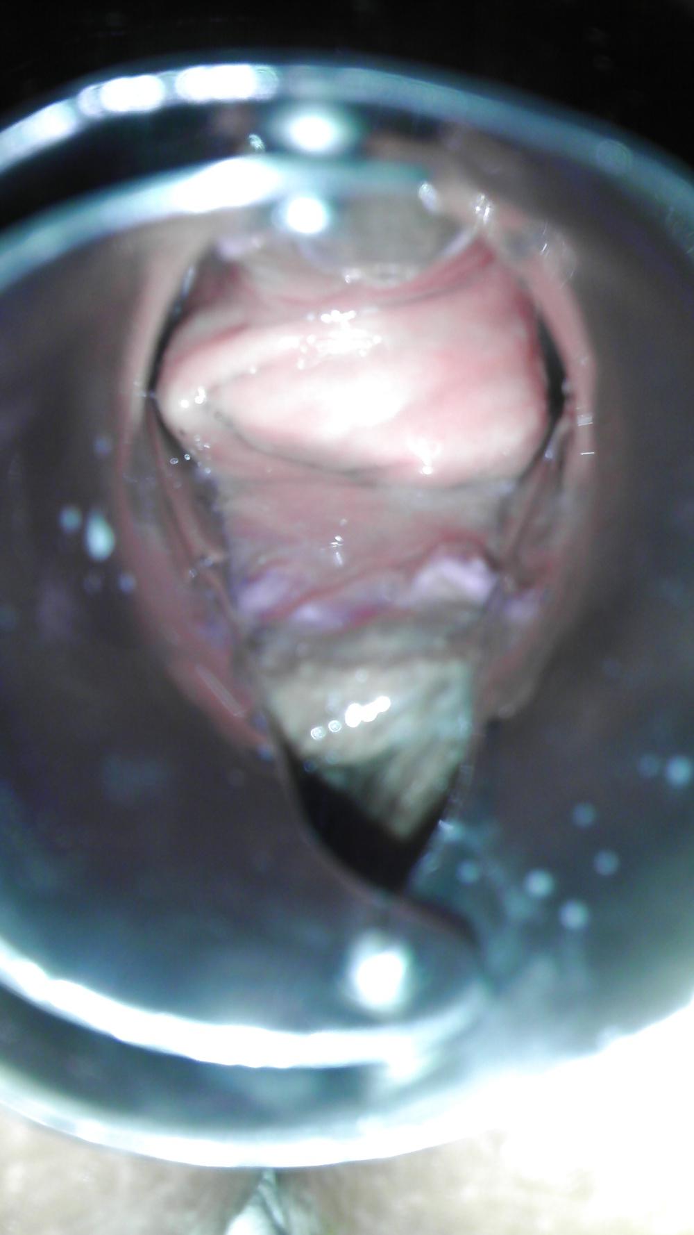 8P Girlfriend gaping speculum play