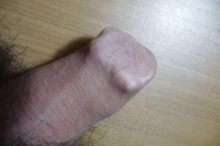 5P Foreskin play with hair clamps (2)