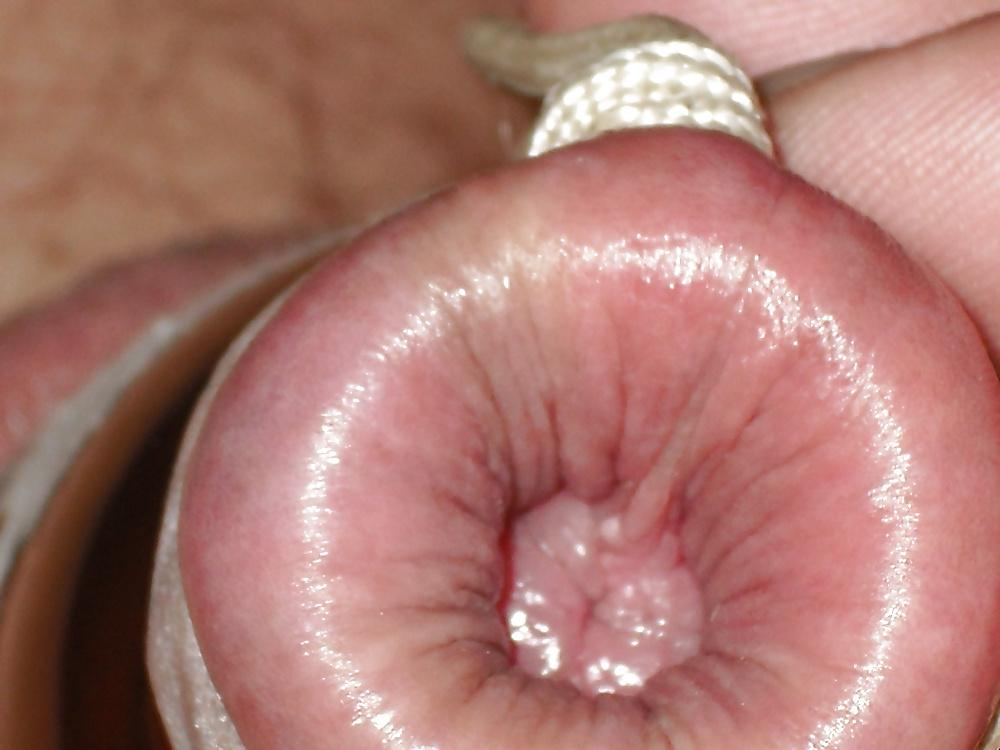 11P FORESKIN PLAY .....