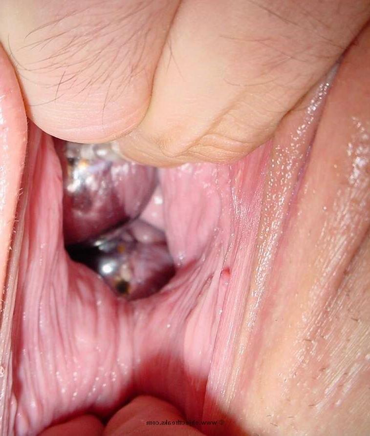 16P bizarre object insertion and fisting