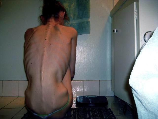 16P skinny anorexic girls posing nude for money