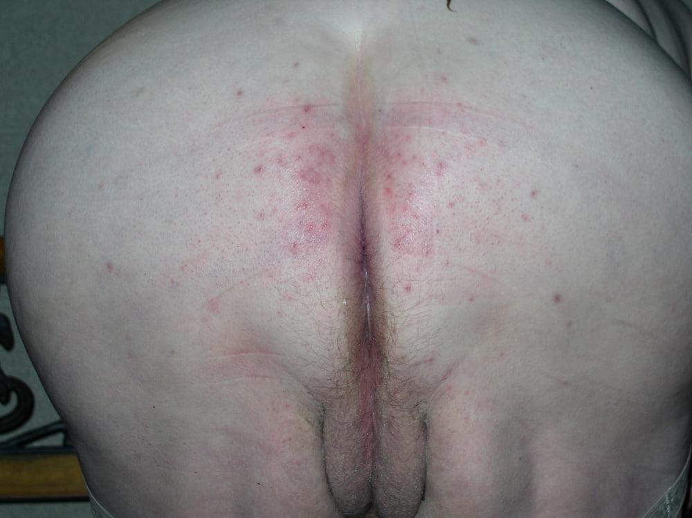 25P Real Women, Real Blemishes