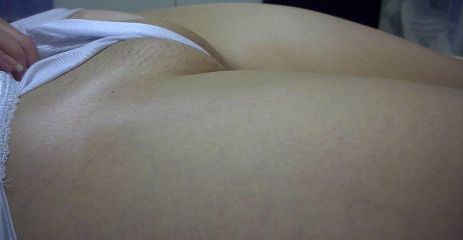 25P Camel Toes