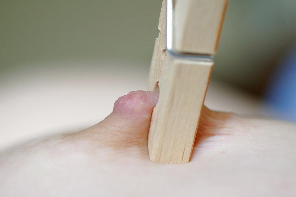 5P Pinched nipple