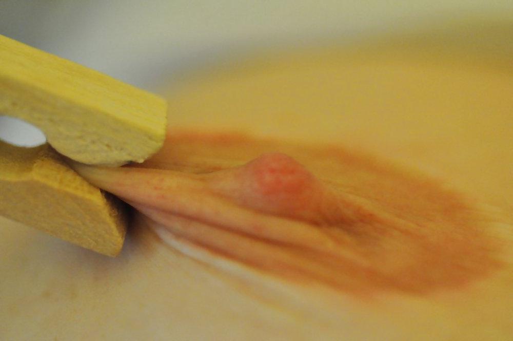 5P Pinched nipple