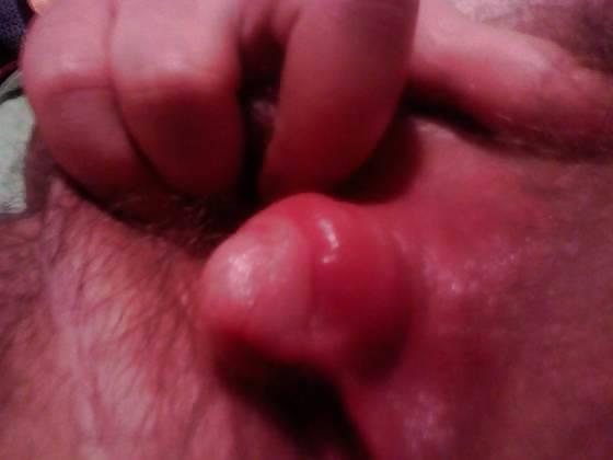 25P Big Clits and FTM Dicklets