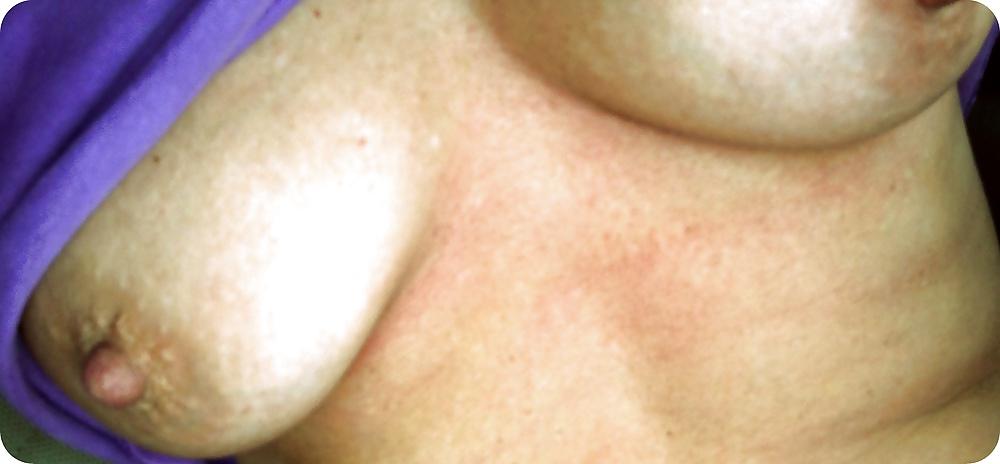 25P My Breast