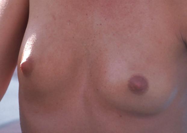 25P Nipple Mix