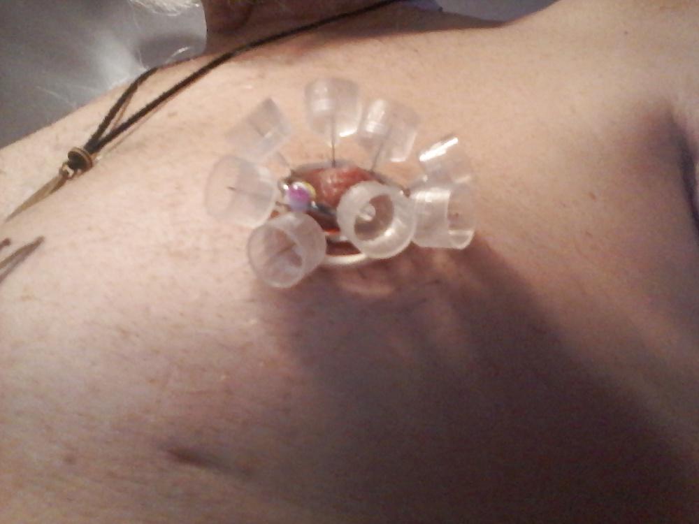 20P Nipple treatment