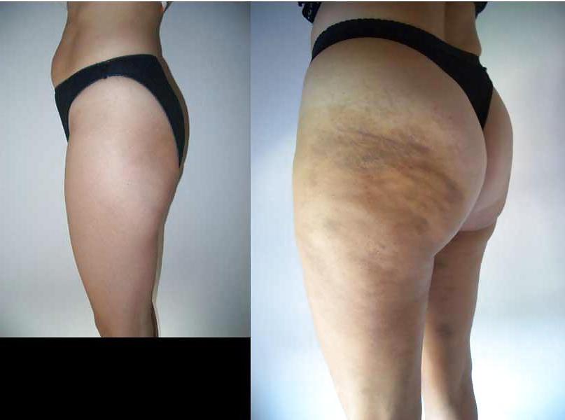 25P Pay to get it or get rid of it before and after