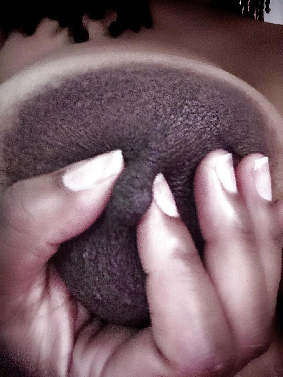 25P Massive dark areolas
