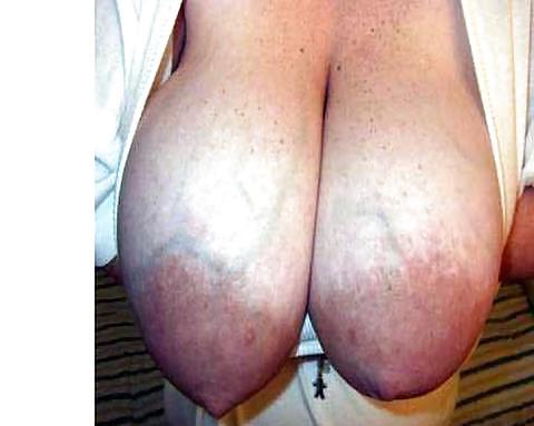 25P Massive dark areolas