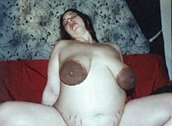 25P Massive dark areolas