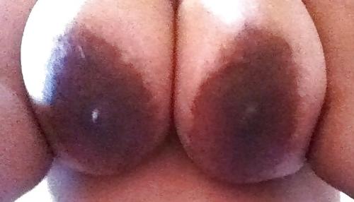 25P Massive dark areolas