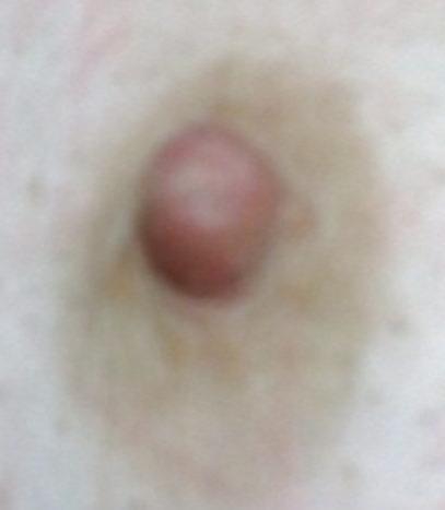 4P Nipple before and after