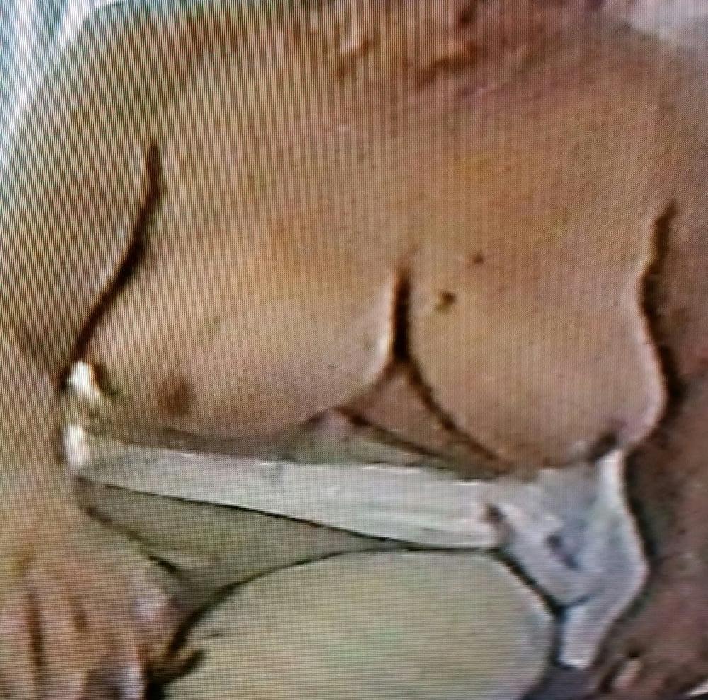 11P 83 y o granny