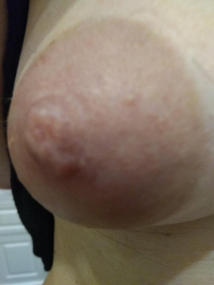 5P Hairy nipples 2