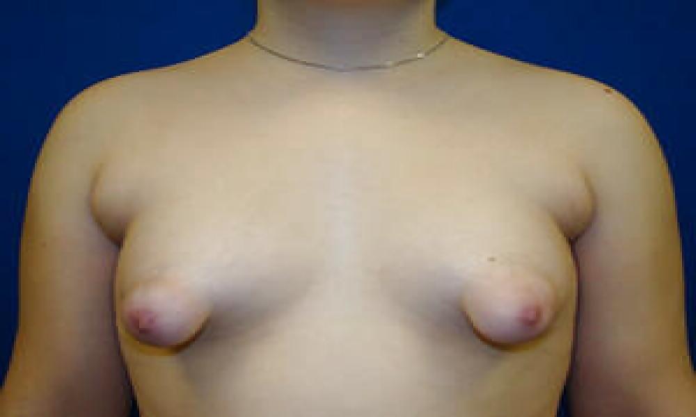 25P Puffy nips 4