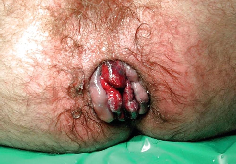 6P Non-porn anal prolapses