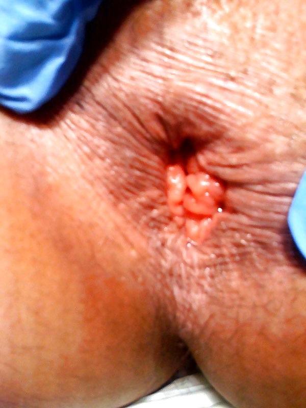 6P Non-porn anal prolapses