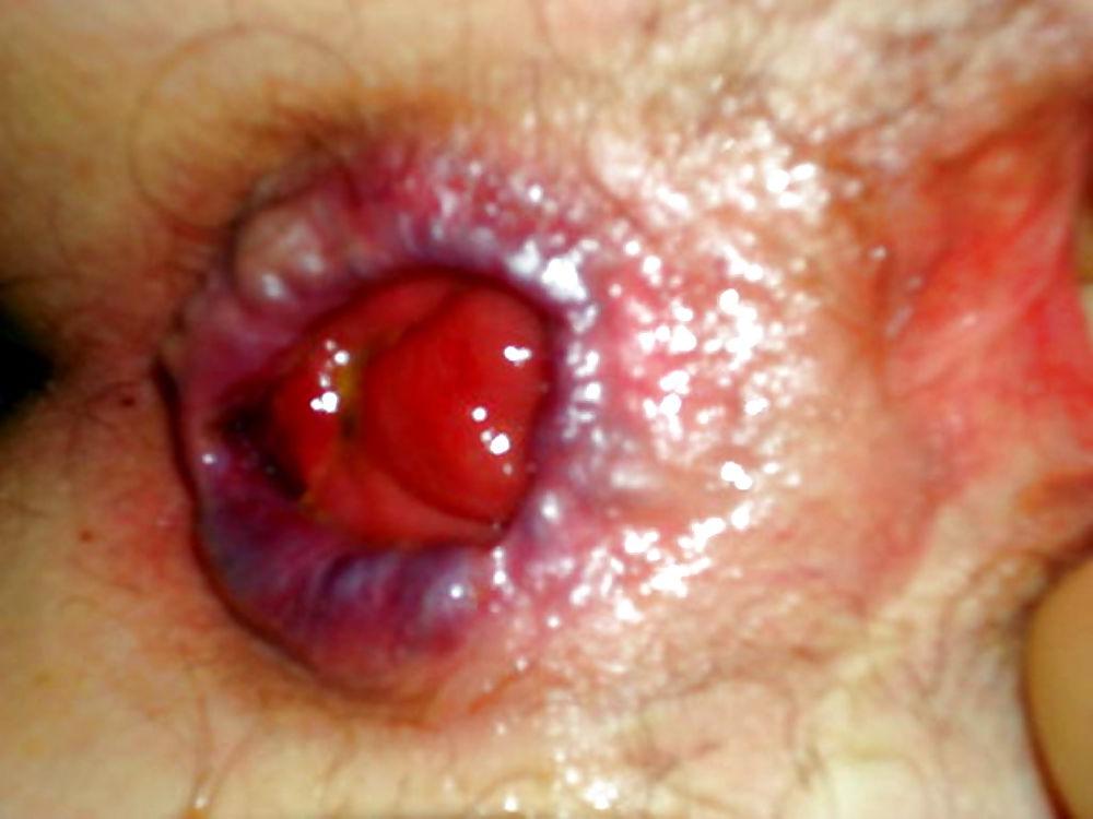 6P Non-porn anal prolapses