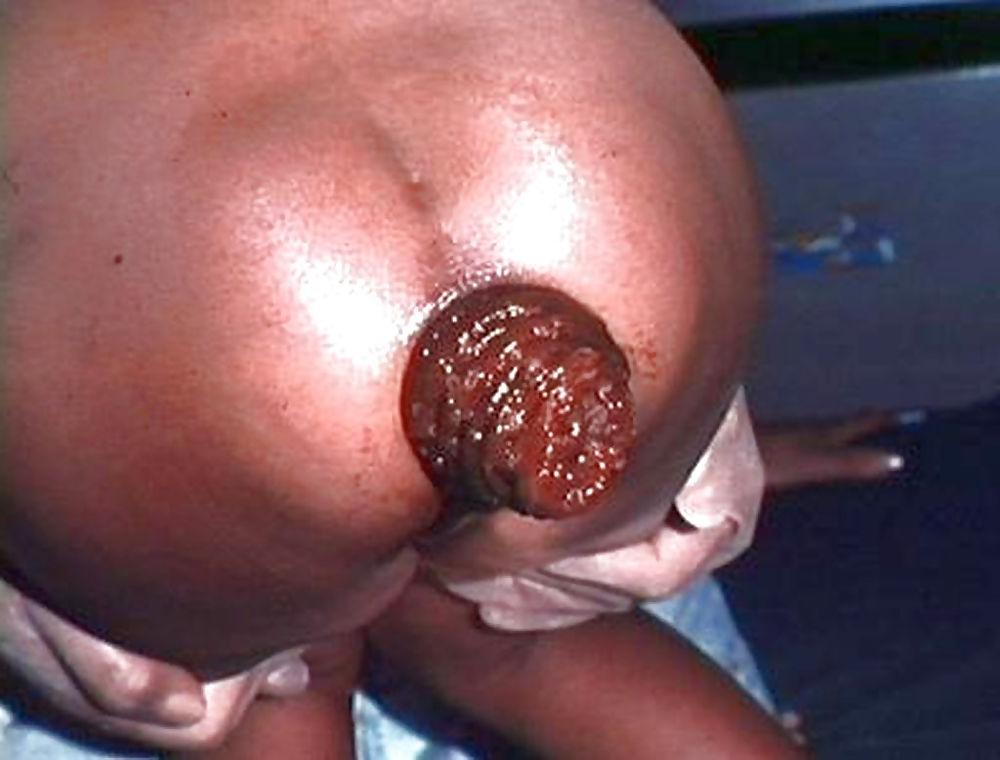 6P Non-porn anal prolapses