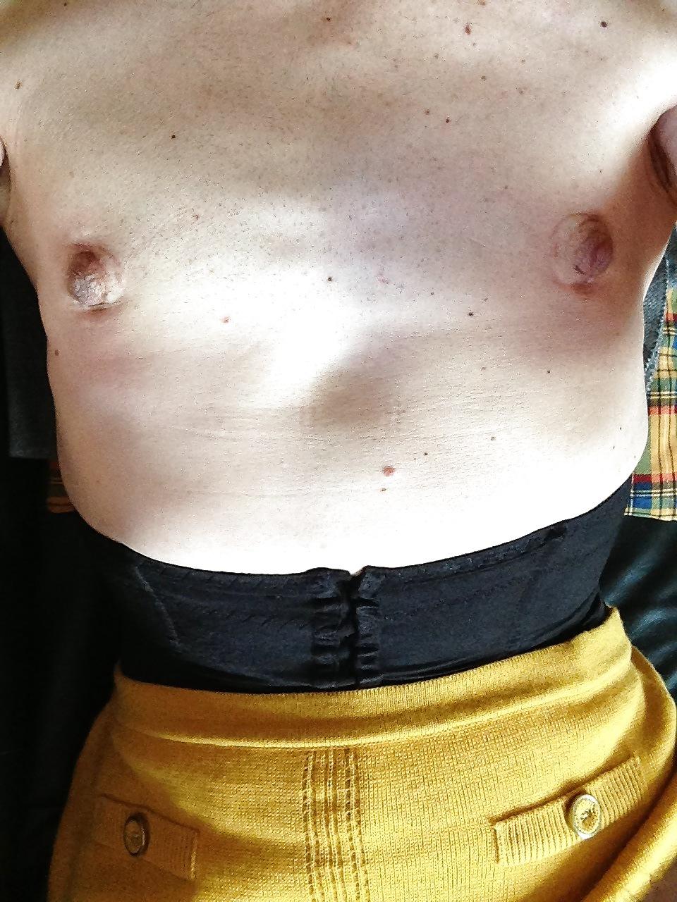 19P NIPPLES STRETCHING