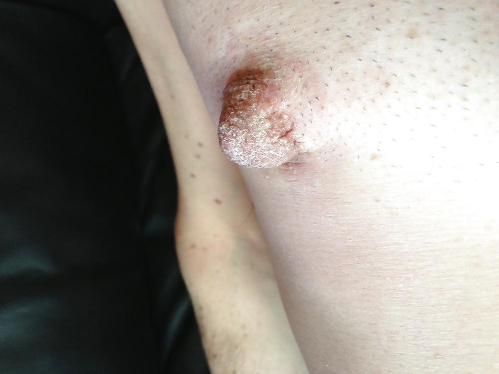 19P NIPPLES STRETCHING