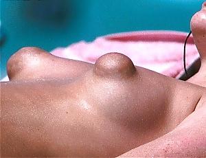 25P Brustwarzen mit grossen Warzenhof Puffy Nipples 