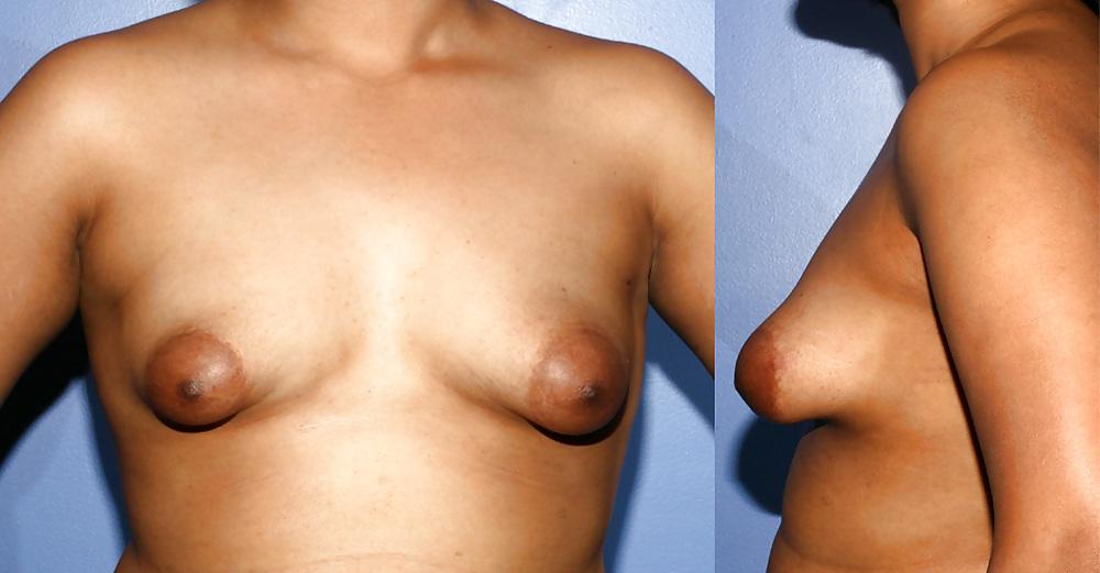 14P All kind of nipples