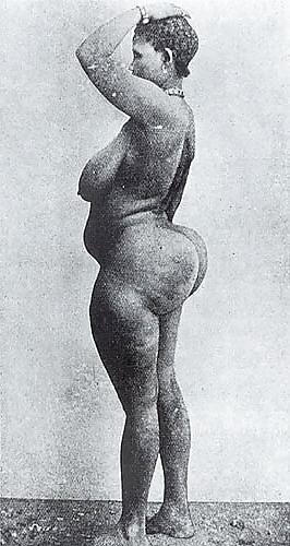 20P STEATOPYHGIA