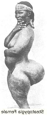 20P STEATOPYHGIA