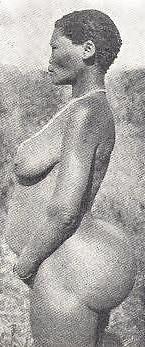 20P STEATOPYHGIA