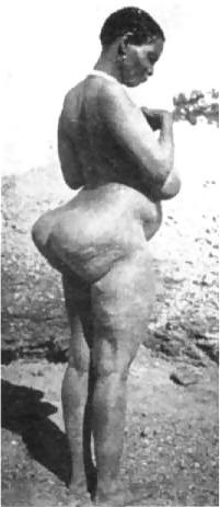 20P STEATOPYHGIA